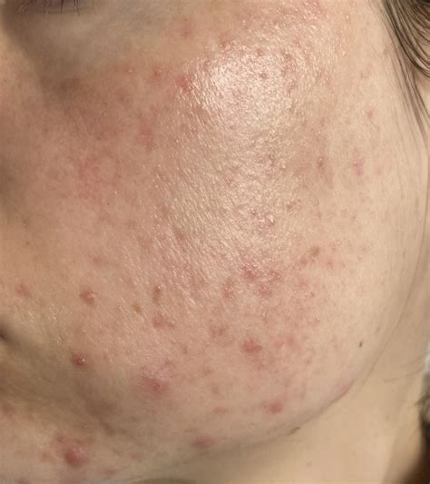 [acne] Damaged skin barrier or just hormonal acne? : SkincareAddiction