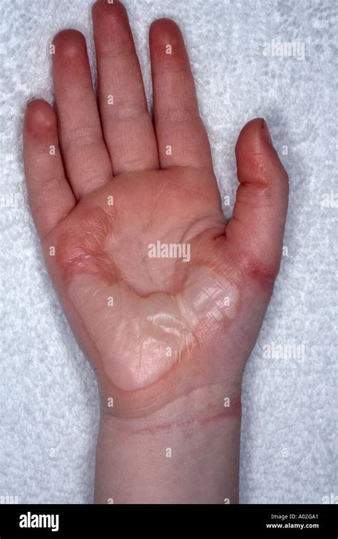 2nd degree burn wound healing 4 year old child Stock Photo - Alamy