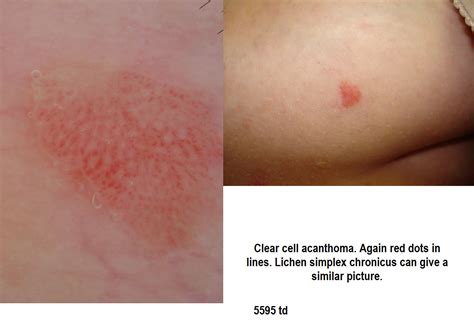 Dermoscopy Made Simple: Clear Cell Acanthoma