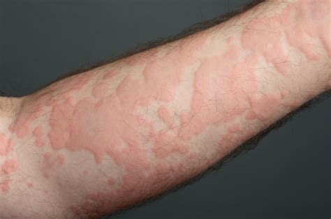 Allergic reaction skin rash treatment - CANhaveTODAY