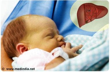 Crigler-Najjar Syndrome-Causes-Risk Factors-Symptoms-Diagnosis ...