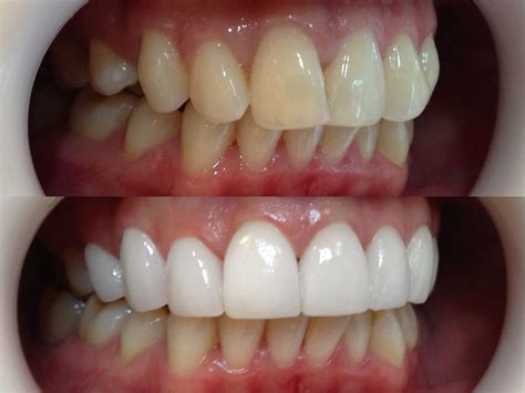 Veneers - Eternal Smiles Dental Centre
