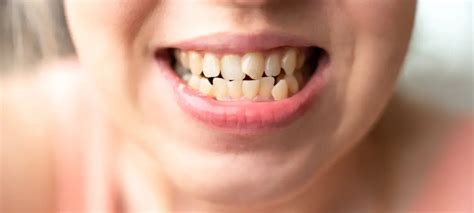 crooked bottom teeth