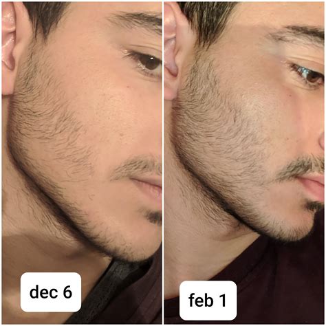 How Long For Vellus Hair To Become Terminal Beard