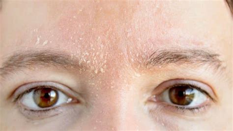 treatments  face skin peeling