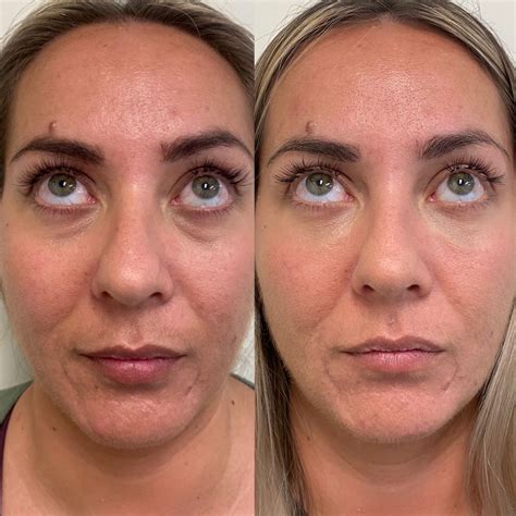 surgical face lift  agnes hogan blog