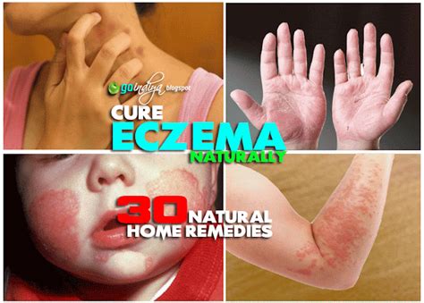 30 Natural Home Remedies for Eczema (Atopic dermatitis) in Kids ...