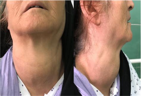 Diffuse thyroid enlargement seen in the patient. | Download Scientific ...
