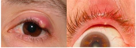 Stye: What is it, causes, treatment and prevention | Eye Health