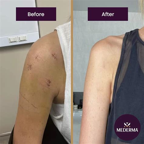 mederma advanced scar gel quick dry oil scar bahrain ubuy