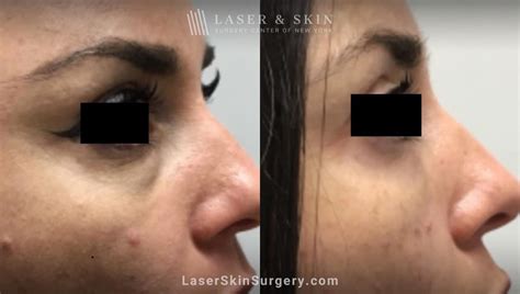 laser treatment  dark  eye circles   york laser ny