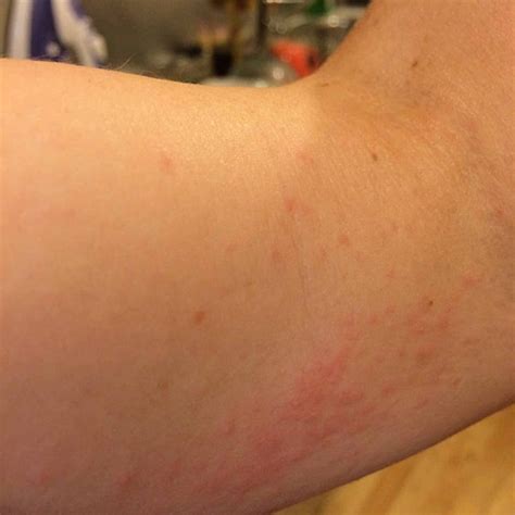 house dust mites  signs  identify treat  prevent