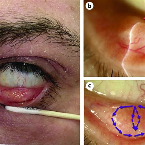 Clinical picture: a overview of the conjunctival tarsal lesion ...
