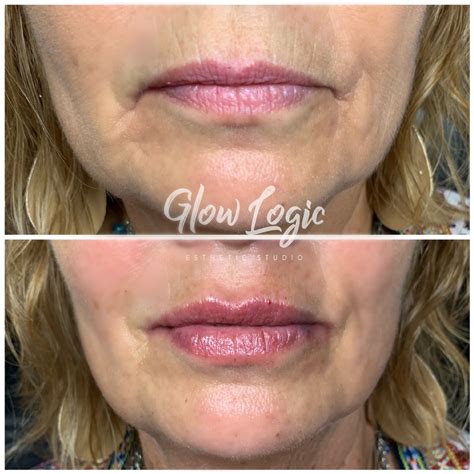 No Needle Lip Filler Before And After at Mitchell Dorgan blog