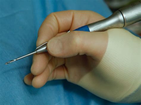 Minimally Invasive Cheilectomy Surgery | David Redfern Orthopaedic Surgeon