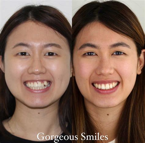 Braces Before And After Pictures - Gorgeous Smiles