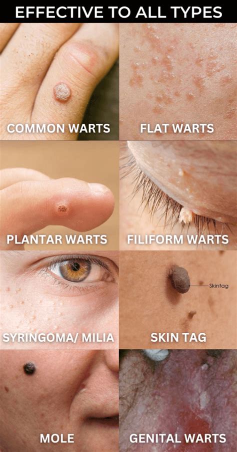 Warts Remover Cream (Premium) – Dranox.com