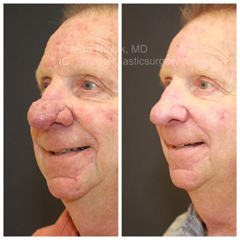 Rhinophyma Reduction St. Louis | Nayak Plastic Surgery