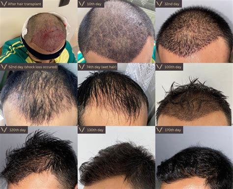 hair transplant growth timeline day  day month  month