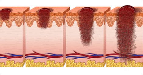 Skin Cancer Stages - CancerWalls
