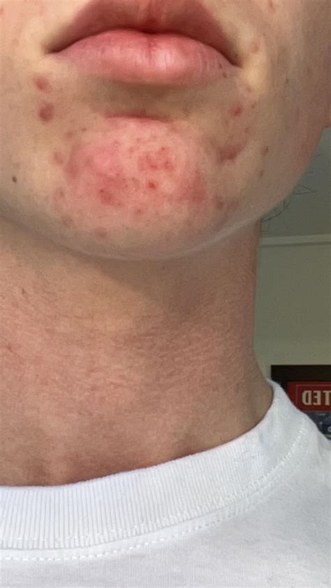 Chin Acne Scars Acne Scar Removal | Pulse Light Clinic London