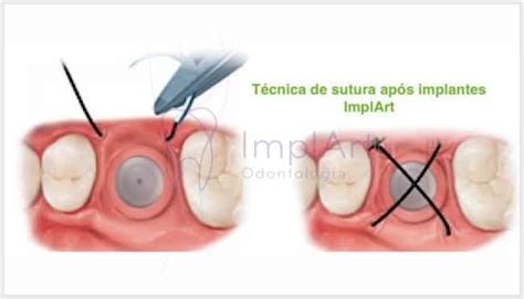 Pus No Implante Dentario O Que Fazer - Pré e pós operatório de implantes dentários -Clinica ImplArt