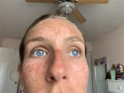 Can I stop this peeling? : r/tanning
