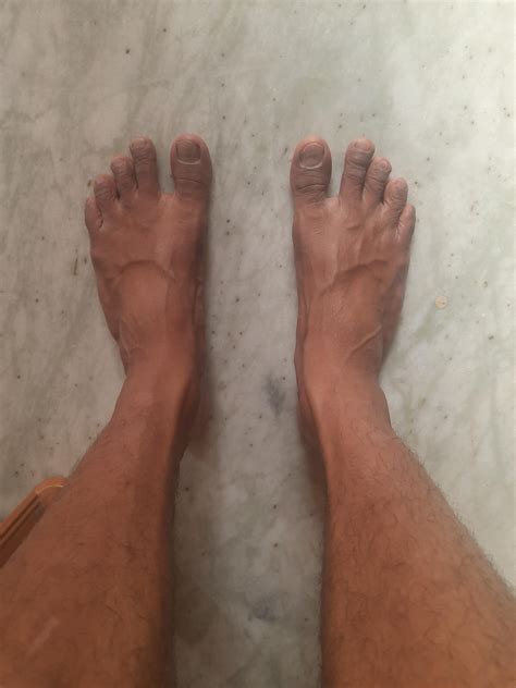 Do I have Bunion? : r/bunions