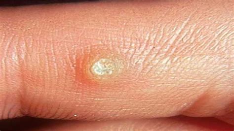 how to get rid of a wart on your finger without duct tape - YouTube
