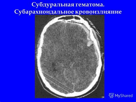 Презентация на тему: "Лучевая диагностика черепно-мозговой травмы ...