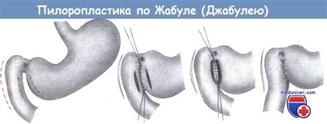 Этапы и техника пилоропластики по Гейнеке-Микуличу, Финнею, Джабулею
