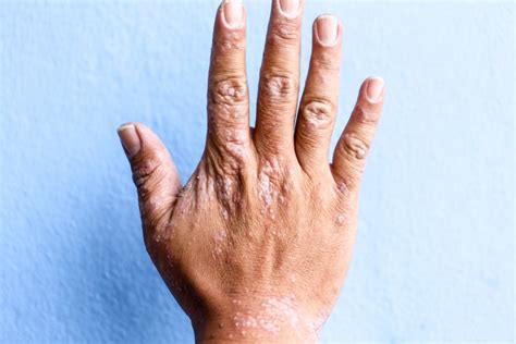 eczema treatment   symptoms explained huffpost health