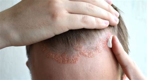 Psoriasis | Ursache | Formen | Behandlung - HEROLD