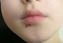 impetigo symptoms diagnosis  treatment bmj  practice