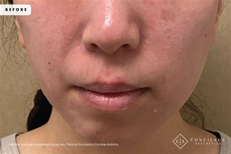 B + A: Laser IPL - Brown Spots