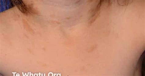 Cutaneous mastocytosis image