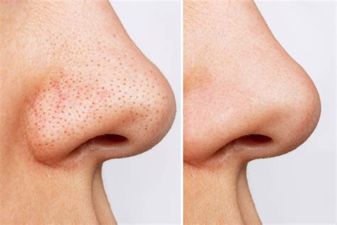 What's The Buzz About Unbelievable Blackhead Removal 2024? Image 6