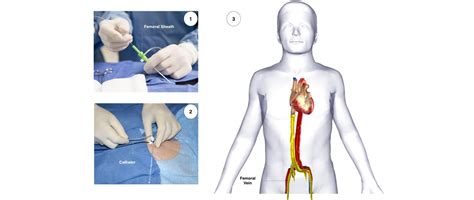 af ablation  heart cardiology