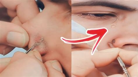 The Shocking Truth About Unbelievable Blackhead Removal On YouTube