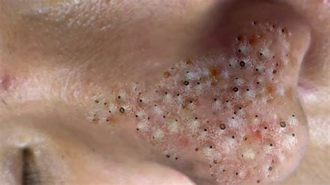 Unbelievable Blackhead Removal 2024: Get Clear Skin FAST! - ocdk6gf