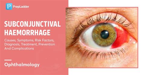 Subconjunctival Haemorrhage: Causes, Symptoms, Risk Factors, Diagnosis ...