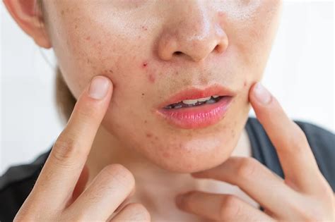 types  acne    treat  hollywood institute
