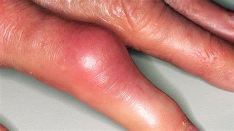 Gout arthritis Pictures HD - Signs, Symptoms, Images, Photos and ...