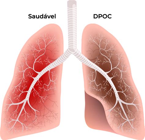O Que Significa Dpoc - Fisiopatologia da DPOC e cascata inflamatória
