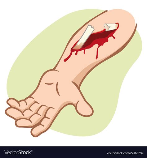 Arm wich compound fracture showing broken bone Vector Image