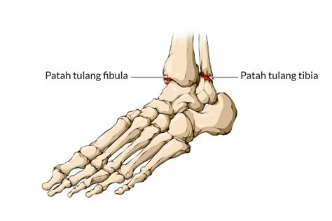 Patah Pergelangan Kaki - Gejala dan mengobati - Alodokter