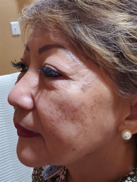 Aesthetics Treatments - Phoenix anti-aging, PRP, PRF, Microneedling and