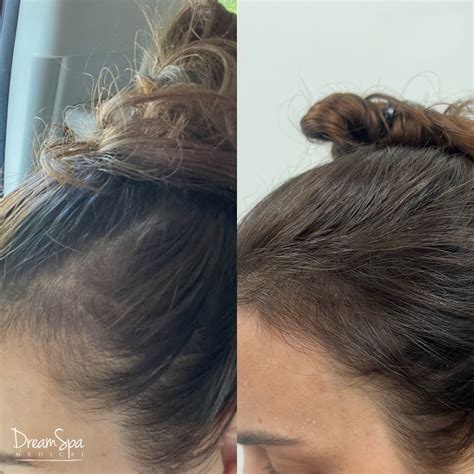 Non-Surgical Hair Restoration: PRP Hair Injections - Dream Spa Medical
