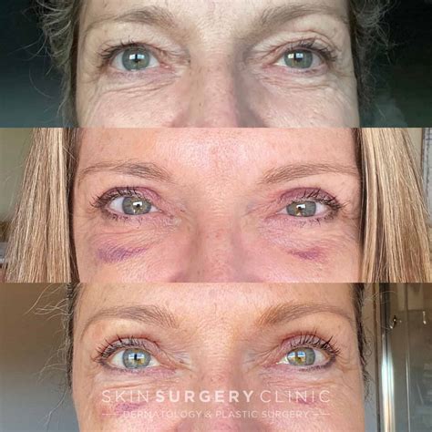 How Much Does Blepharoplasty Cost Blepharoplasty Cost: Understanding