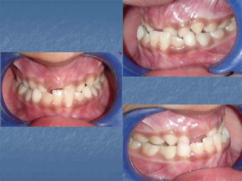 Expansion in orthodontics | PPT